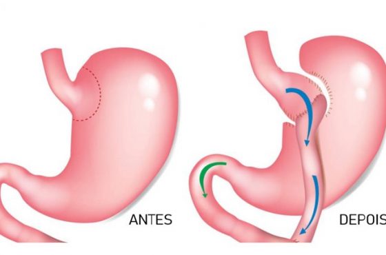 Cirurgia bariátrica